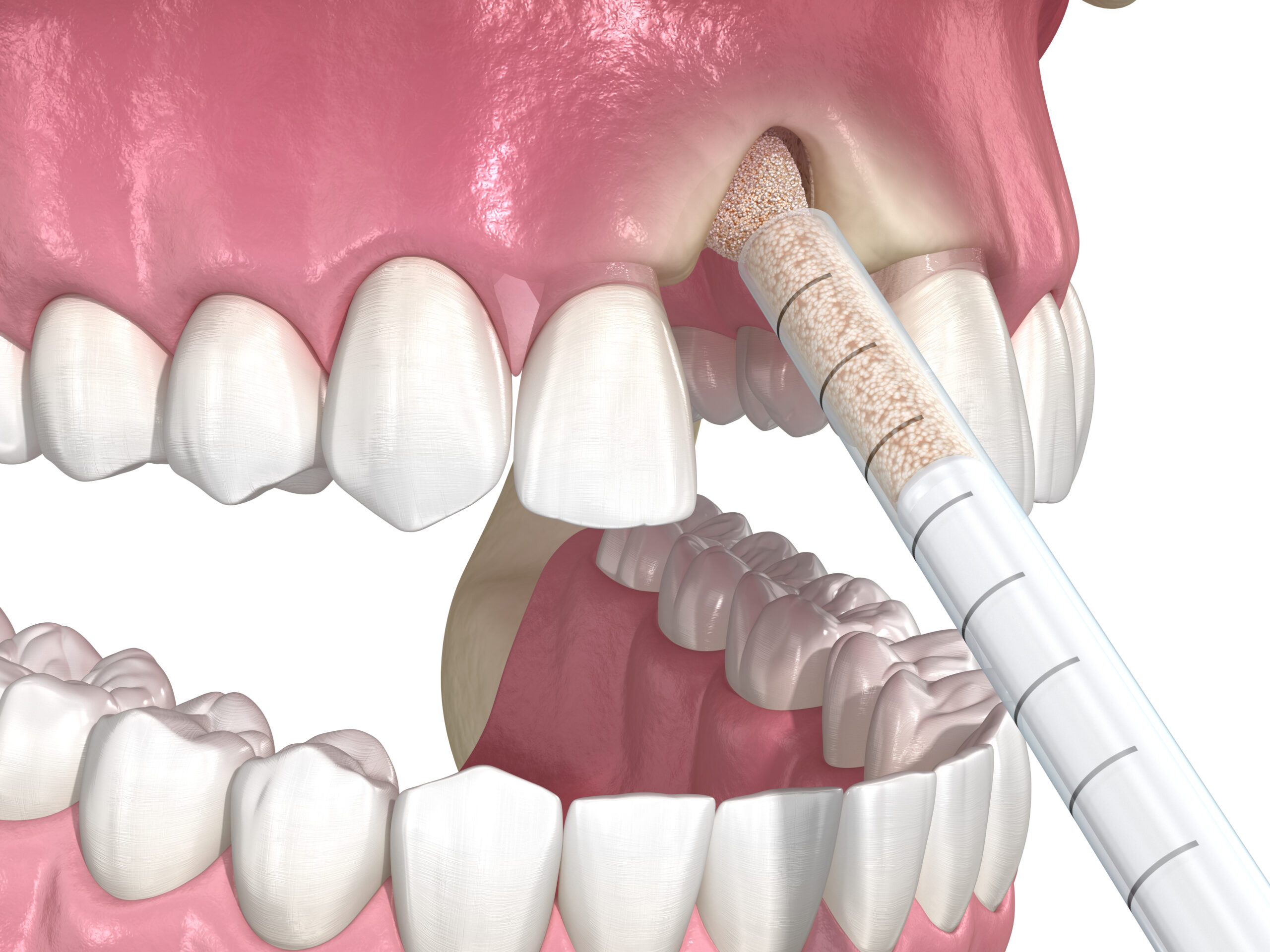 Bone grafting