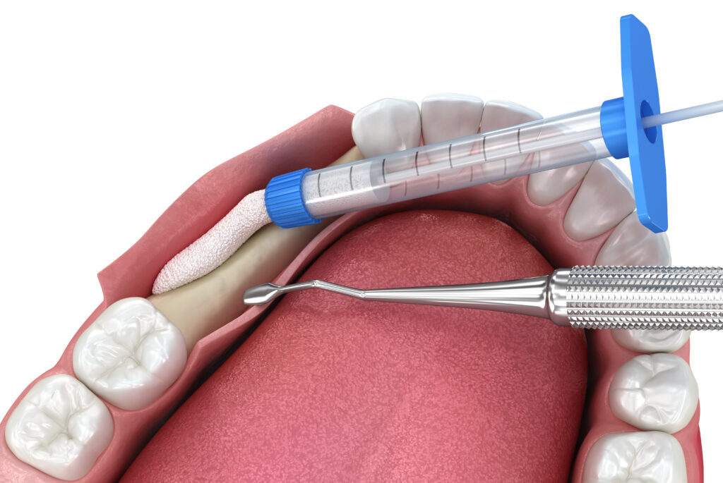 Bone grafting