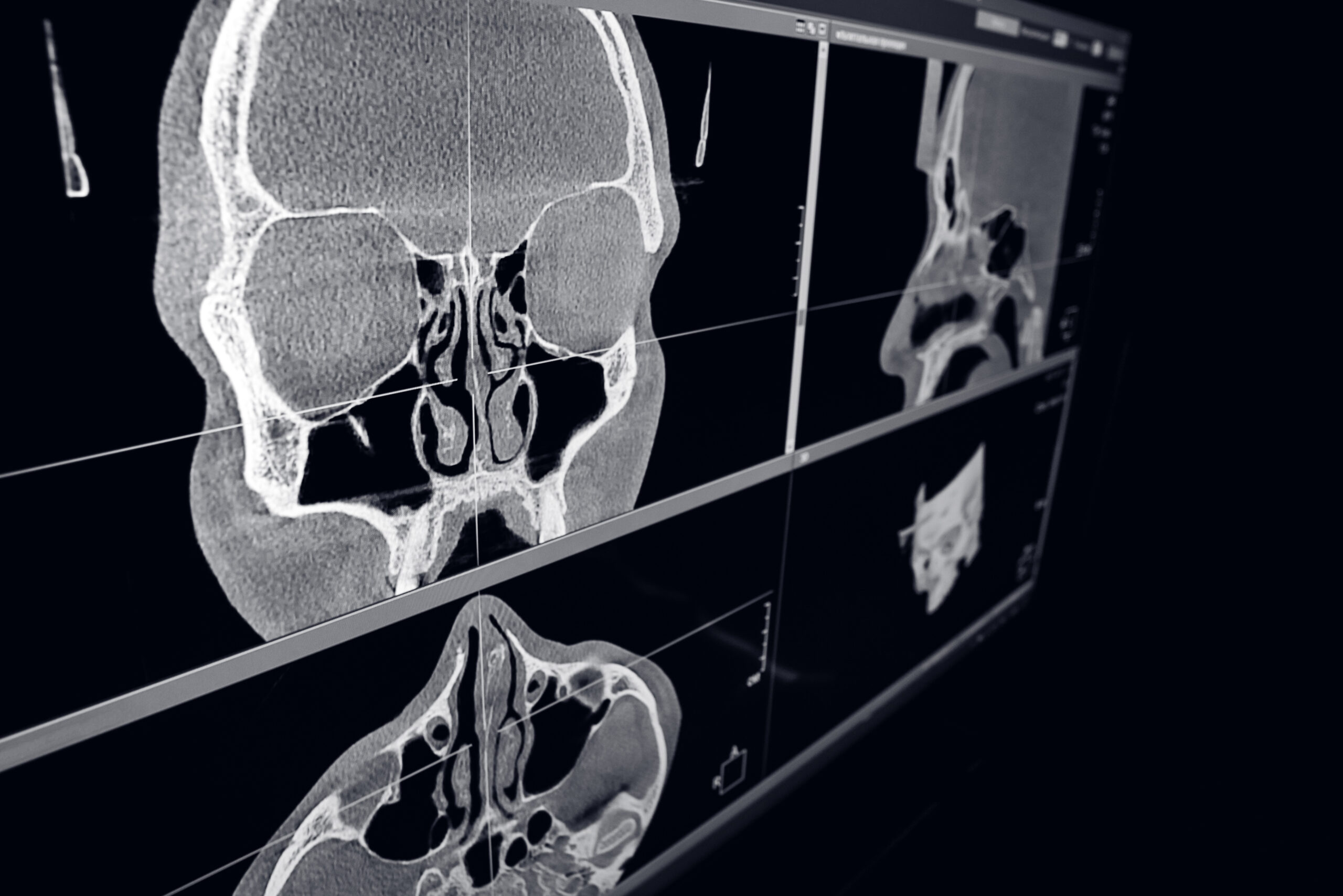 Computed tomography of ENT organs 