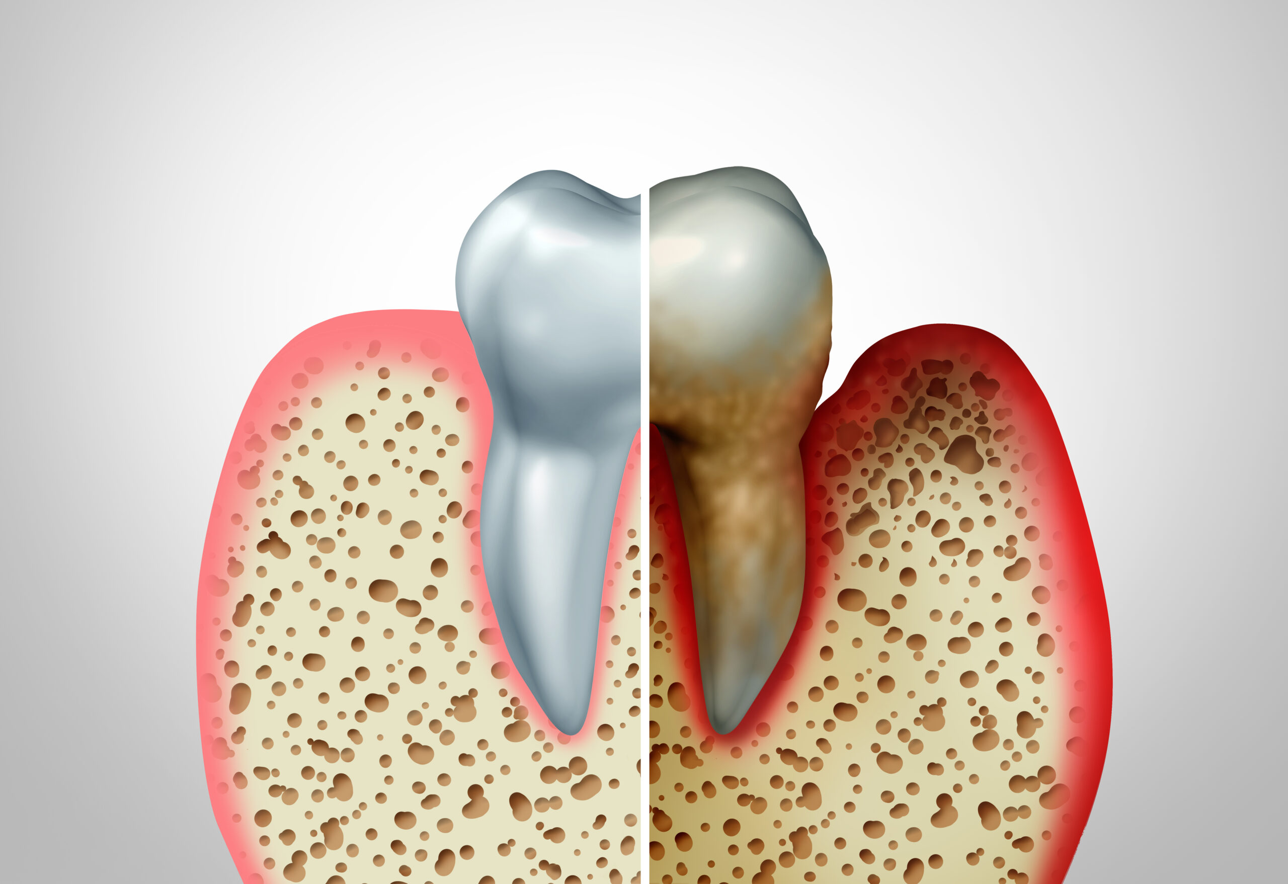 Periodontitis Treatment in Krakow