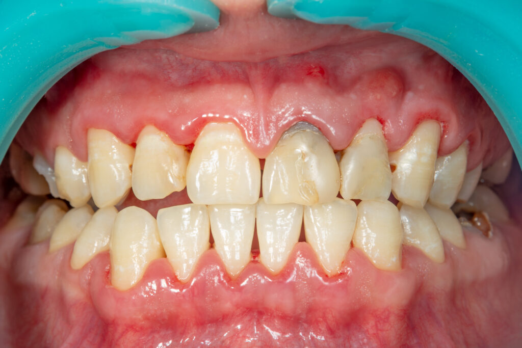 Periodontitis Treatment in Krakow