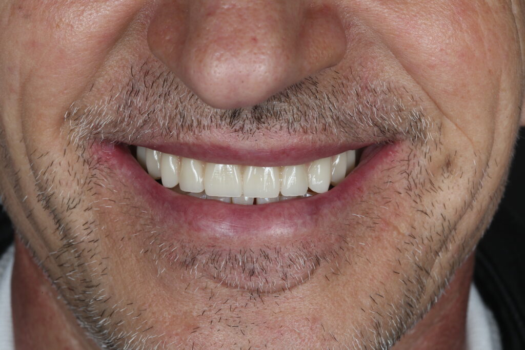 Full upper jaw restoration using the All-on-4 protocol