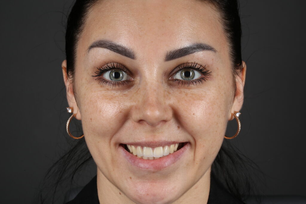 Aesthetic restoration of anterior teeth with ceramic restorations