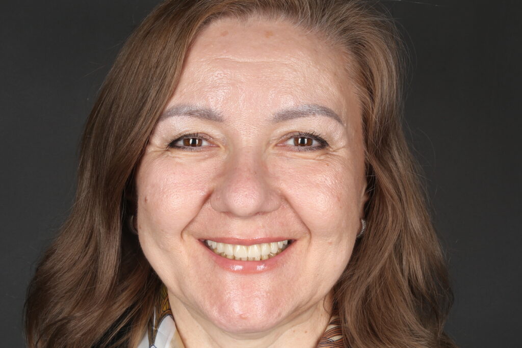Full dental arch restoration with implantation and prosthetic rehabilitation