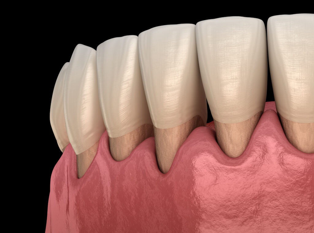 Treatment of gum recession