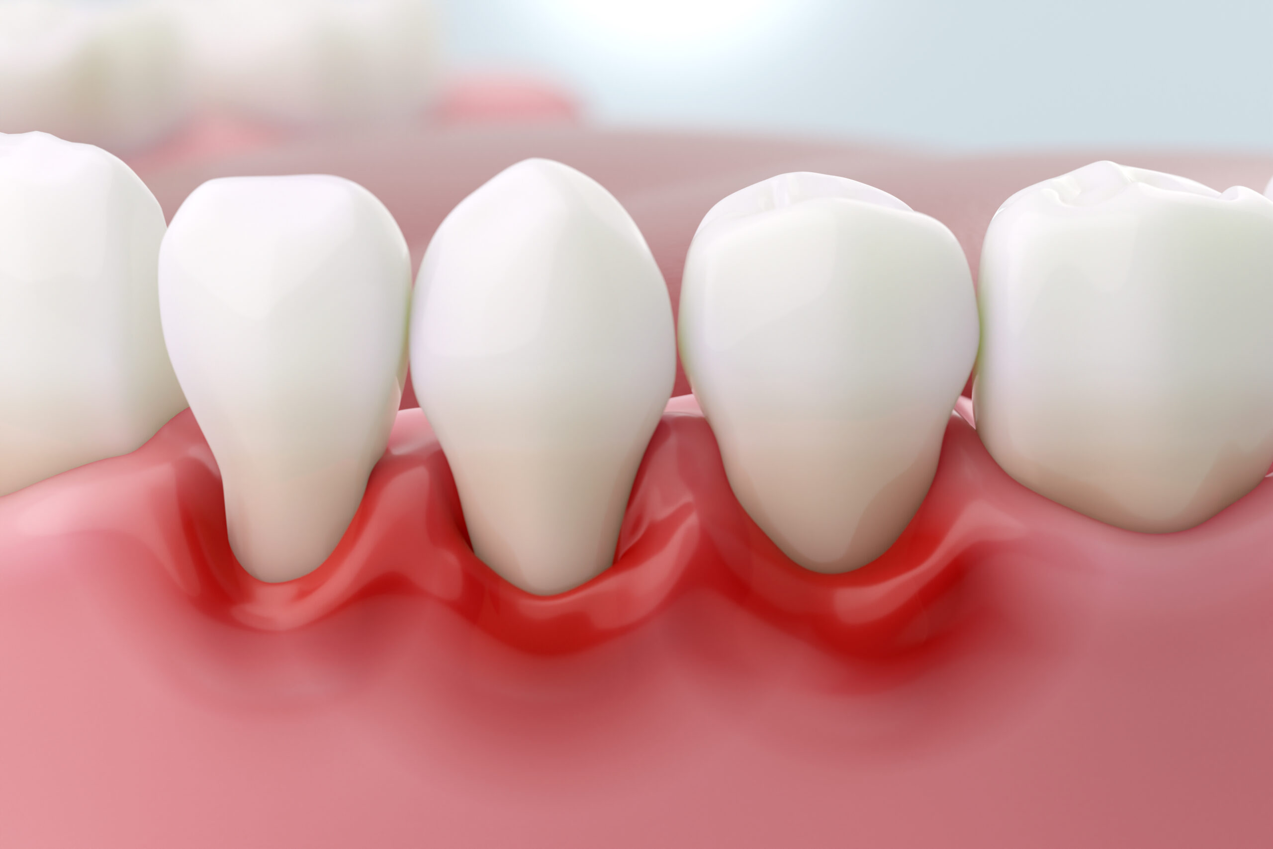 Treatment of gum recession