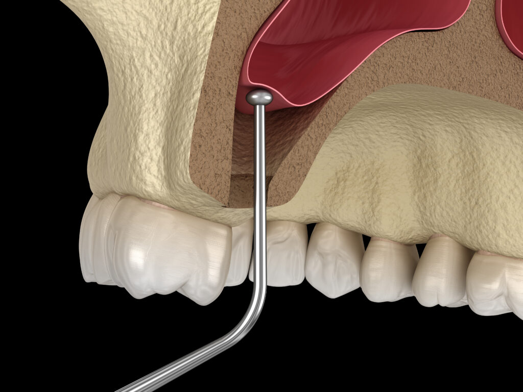 Sinus-lift