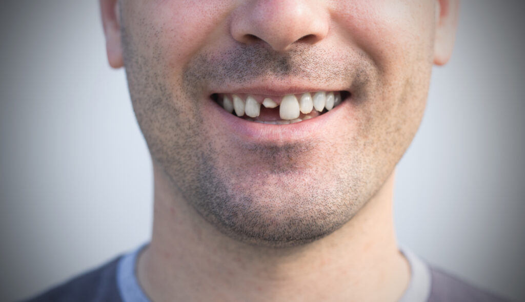 Treatment of dental injuries