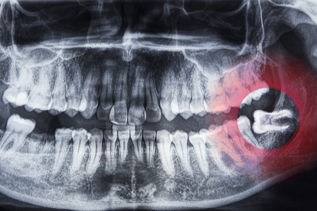 Tooth Extraction Kraków