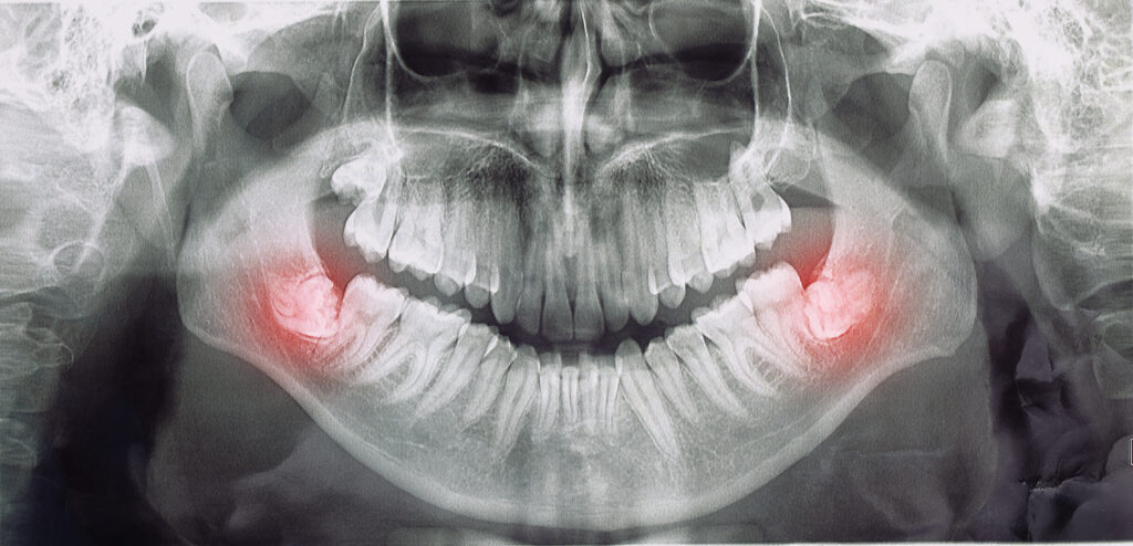 Removal of a Retained Wisdom Tooth