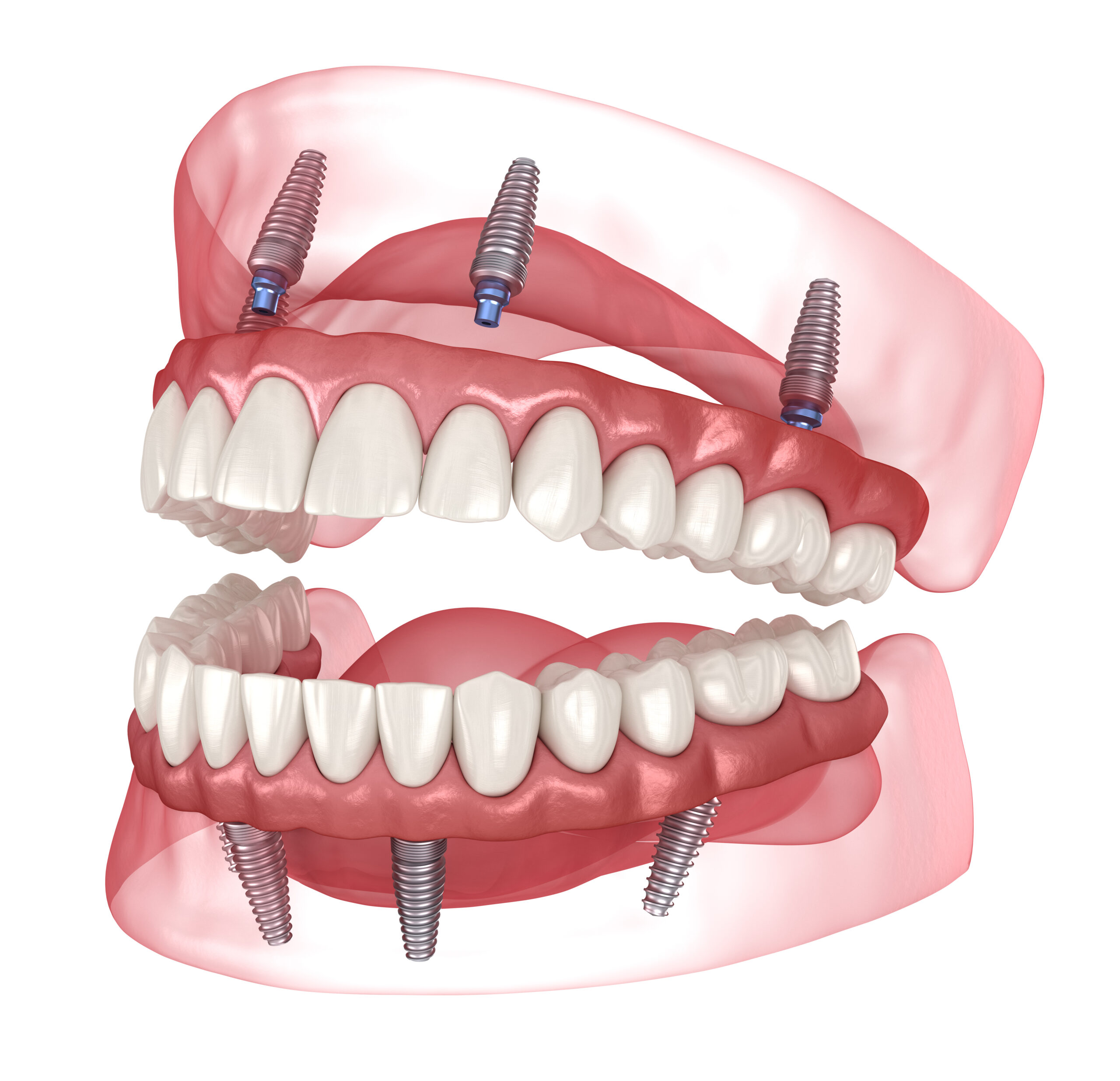 All-on-4 – Metoda proteza na 4 implantach