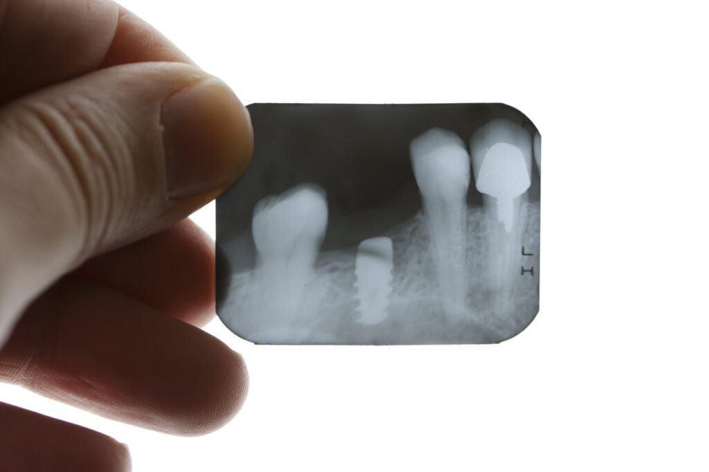 Implants JD Dental