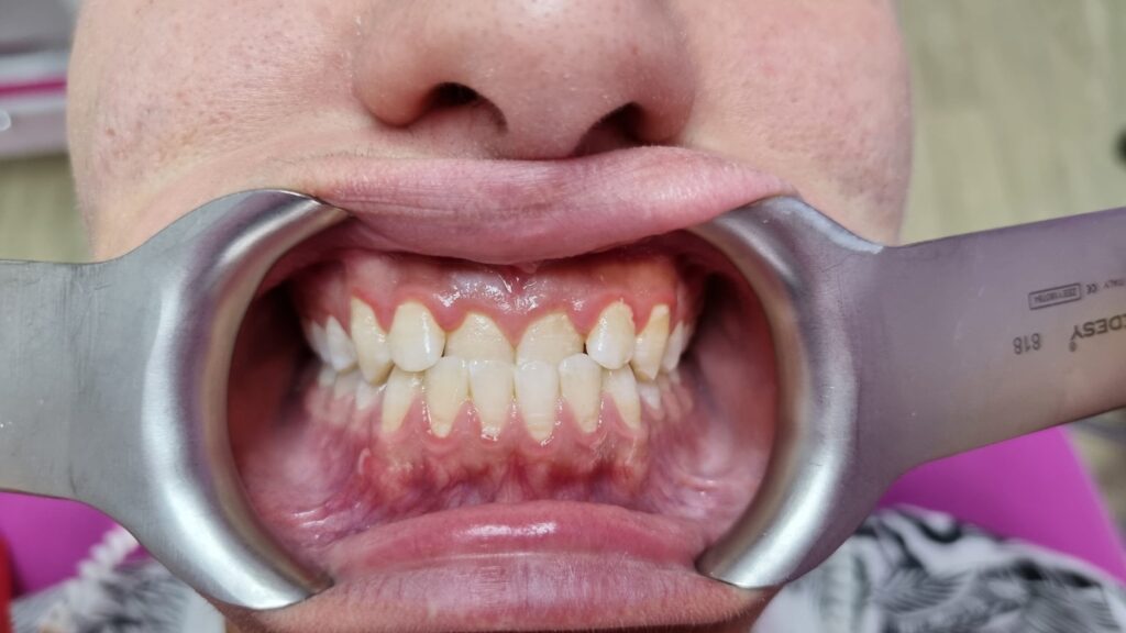Prosthesis
