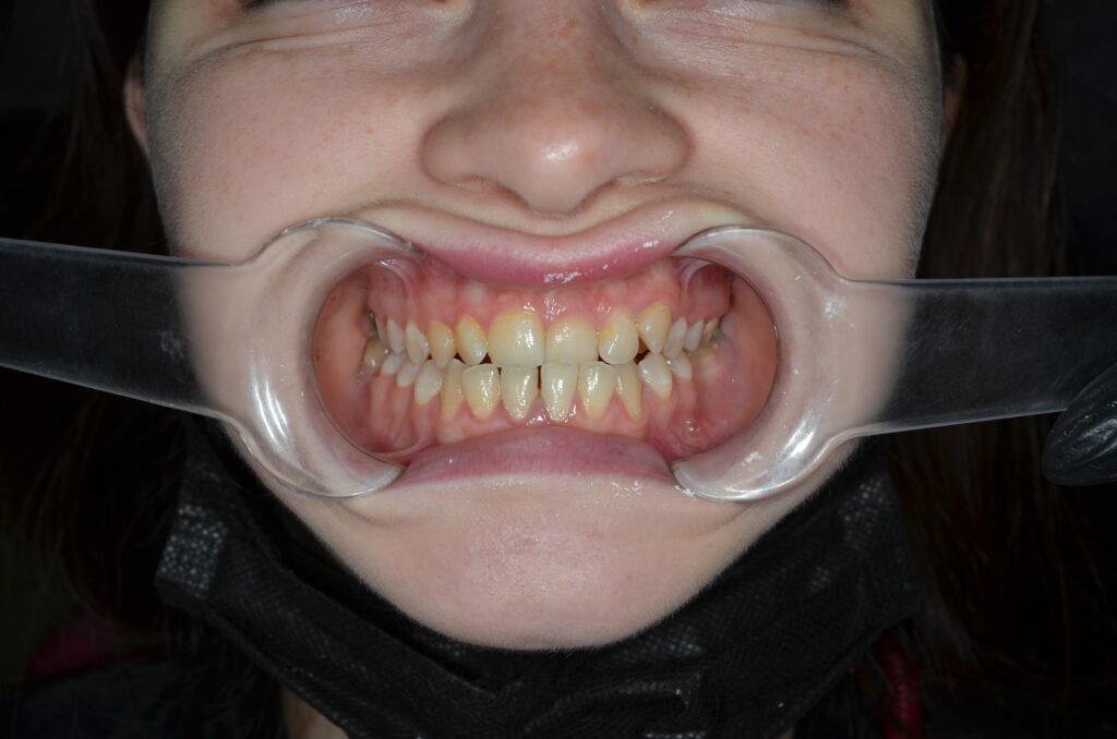 Prosthesis