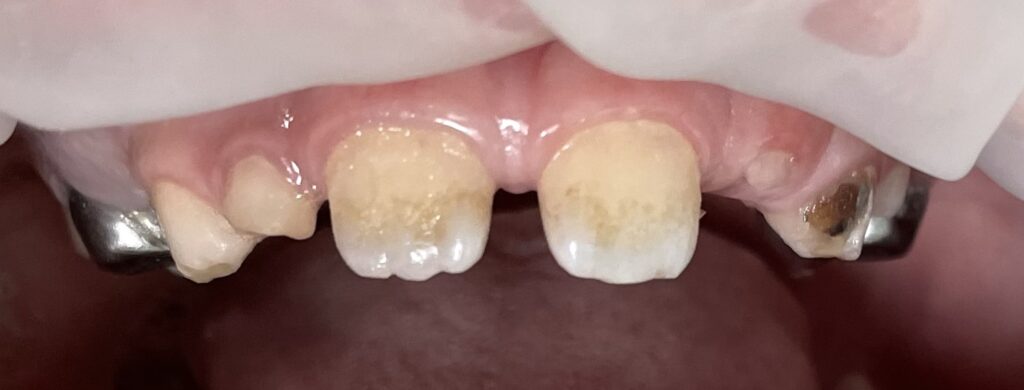 Prosthesis