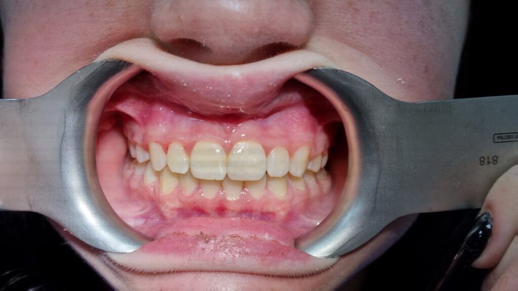 Prosthesis