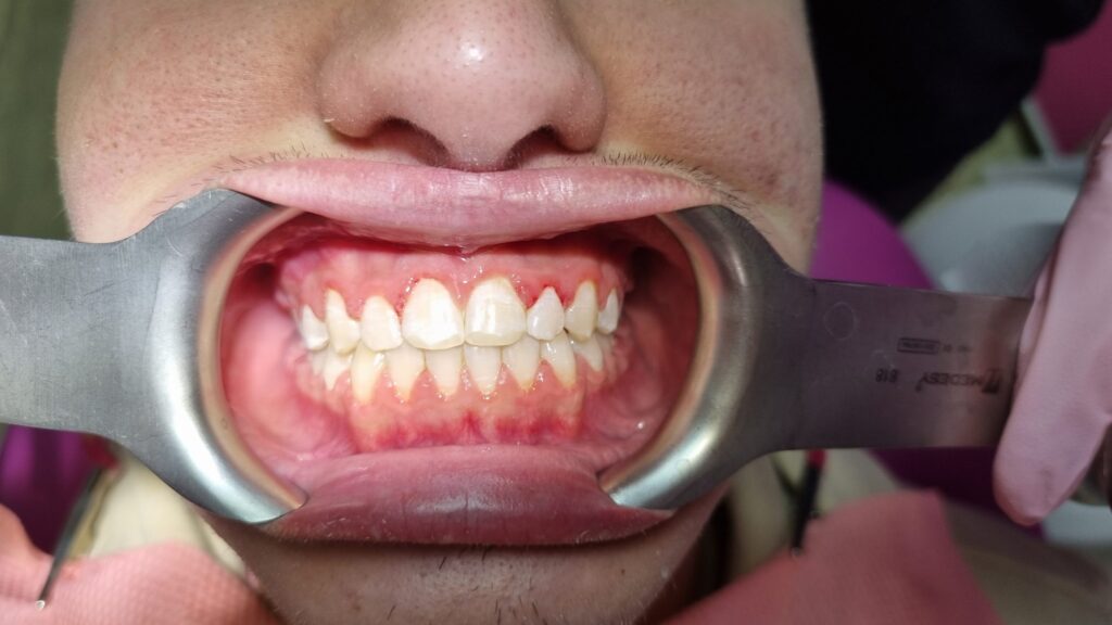 Prosthesis