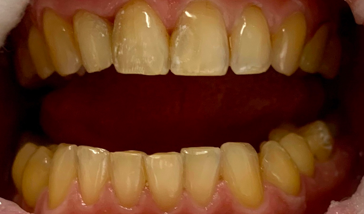 Anti-stress dentistry