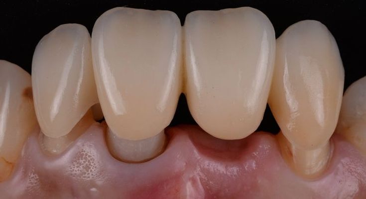 Dental Crowns: Types, Costs, and the Procedure