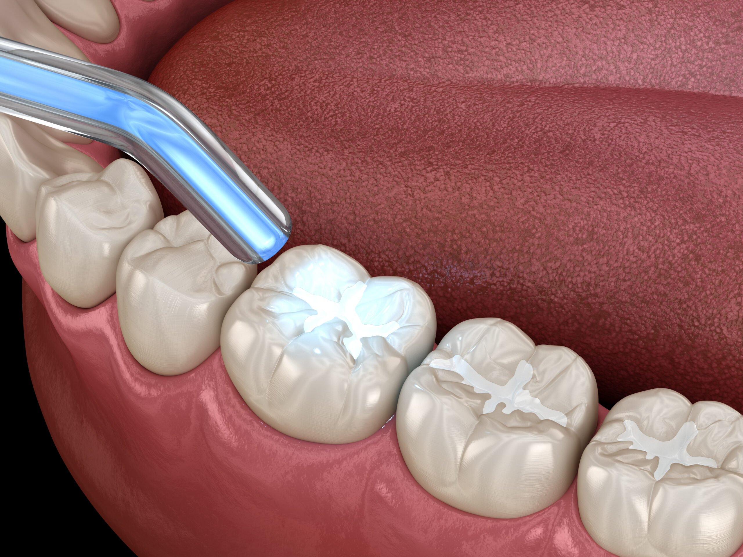 Fissure sealing for children