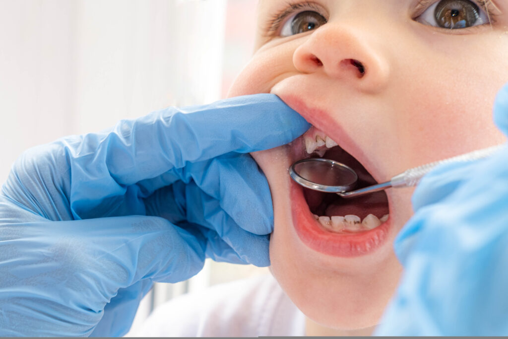 Treatment for early childhood caries