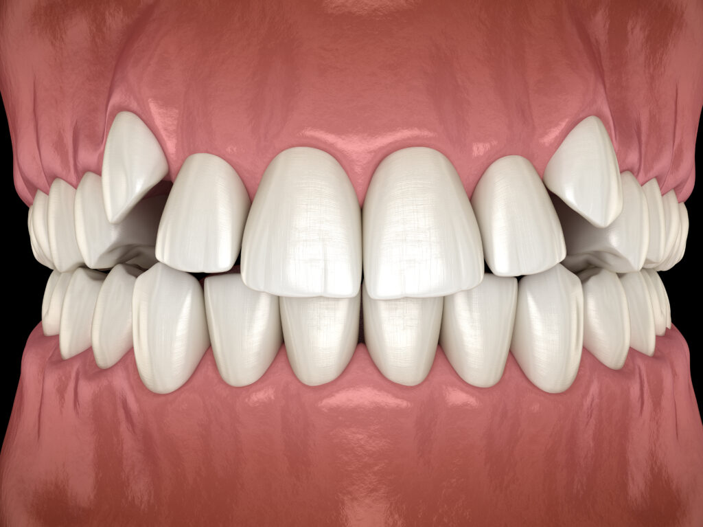 Orthodontic Treatment for Children