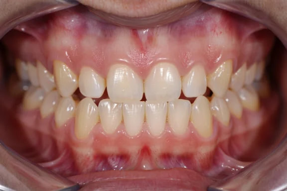 What is dental occlusion and what are the methods of its treatment?