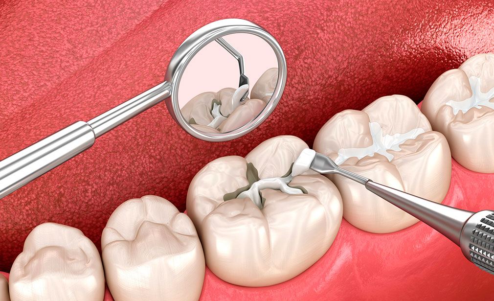 Виды зубных пломб – сколько стоит, как долго служат зубные пломбы и уход после лечения