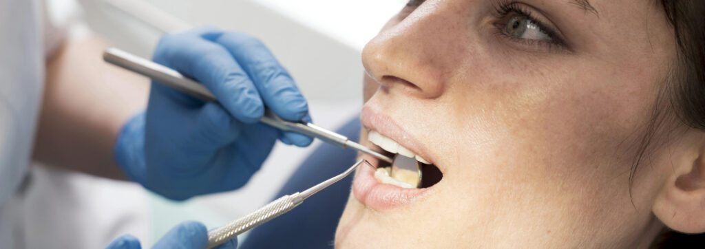 What is tartar removal and how often should you remove it?