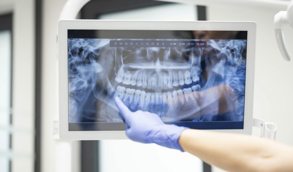 Panoramic X-ray of teeth – effective dental x-ray diagnostics