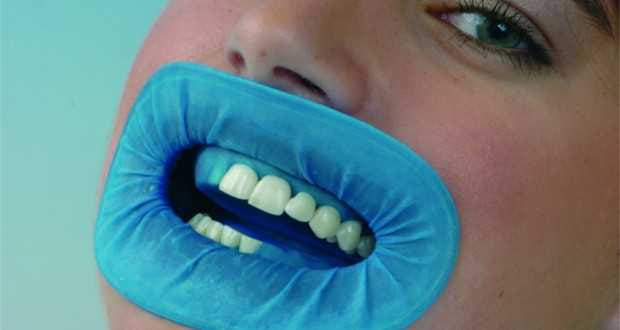 Rubber dam – what is it, main advantages, indications and contraindications