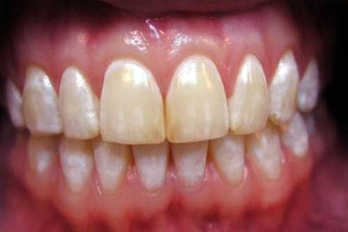 Acid erosion of enamel – main symptoms and treatment