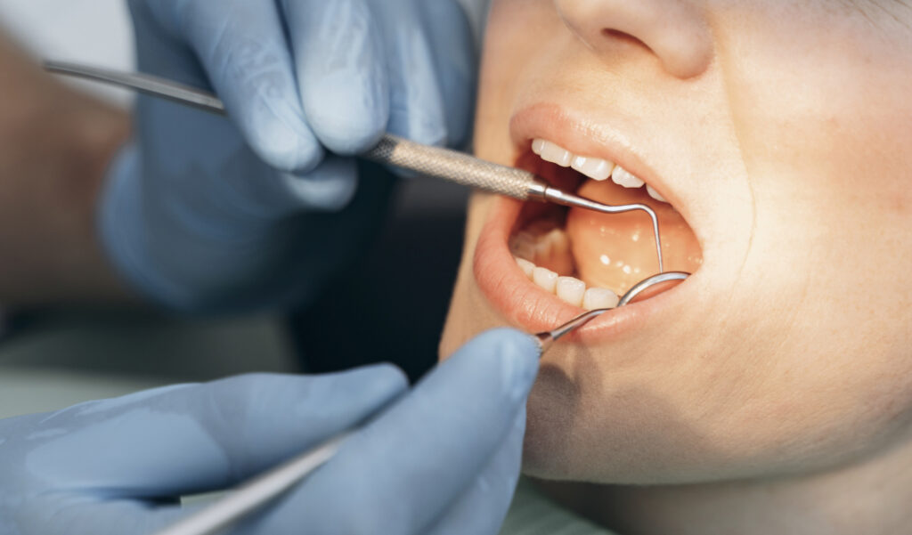 Розуміння ерозії зубів – що це таке, що потрібно знати про ерозію зубів