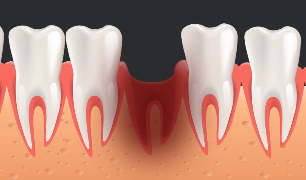 Dry socket – one of the complications after tooth extraction