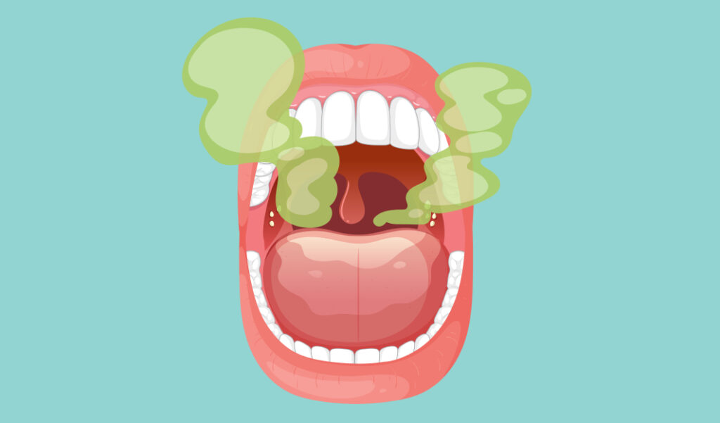 Halitosis – an embarrassing problem that can be fought