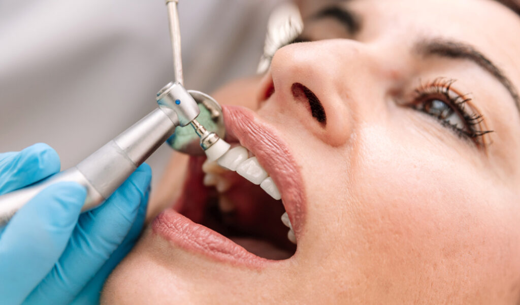 Everything You Need to Know About Tooth Polishing Procedure