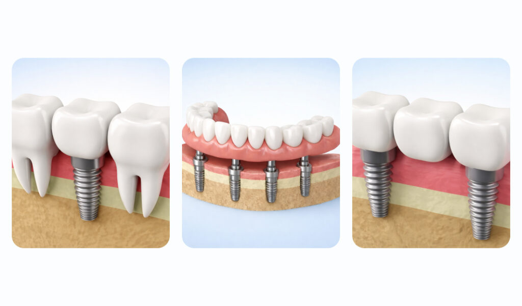 What is Dental Implant Procedure — A Complete Guide