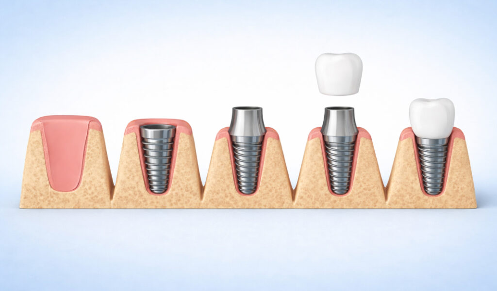 What is Dental Implant Procedure — A Complete Guide