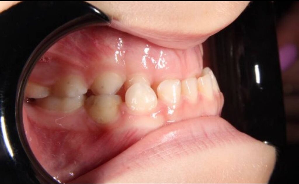 How to avoid surgery in the future — a case study of early orthodontic treatment at age 6