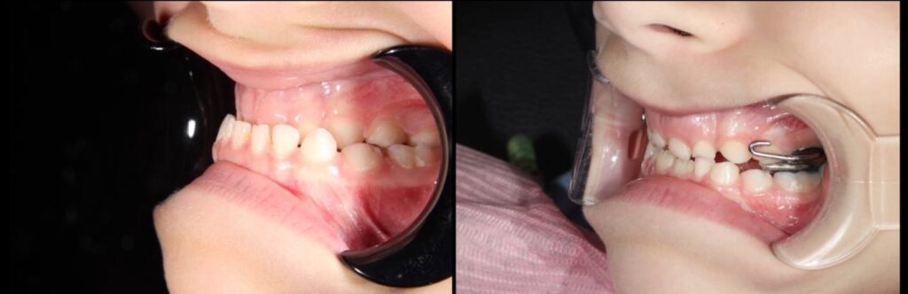 How to avoid surgery in the future — a case study of early orthodontic treatment at age 6