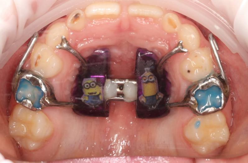 How to avoid surgery in the future — a case study of early orthodontic treatment at age 6