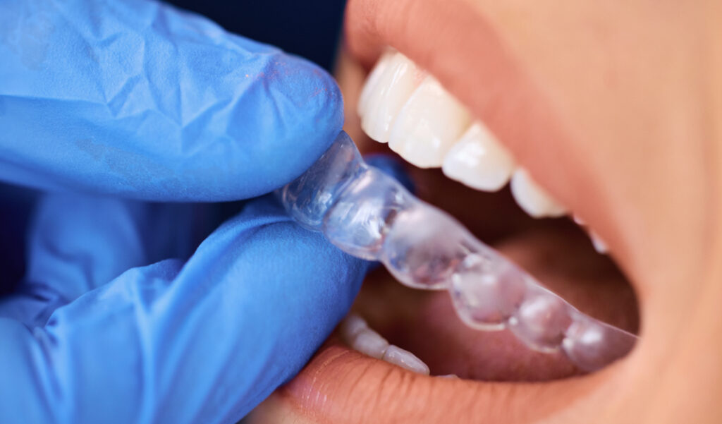 What You Need to Know About Professional Teeth Whitening