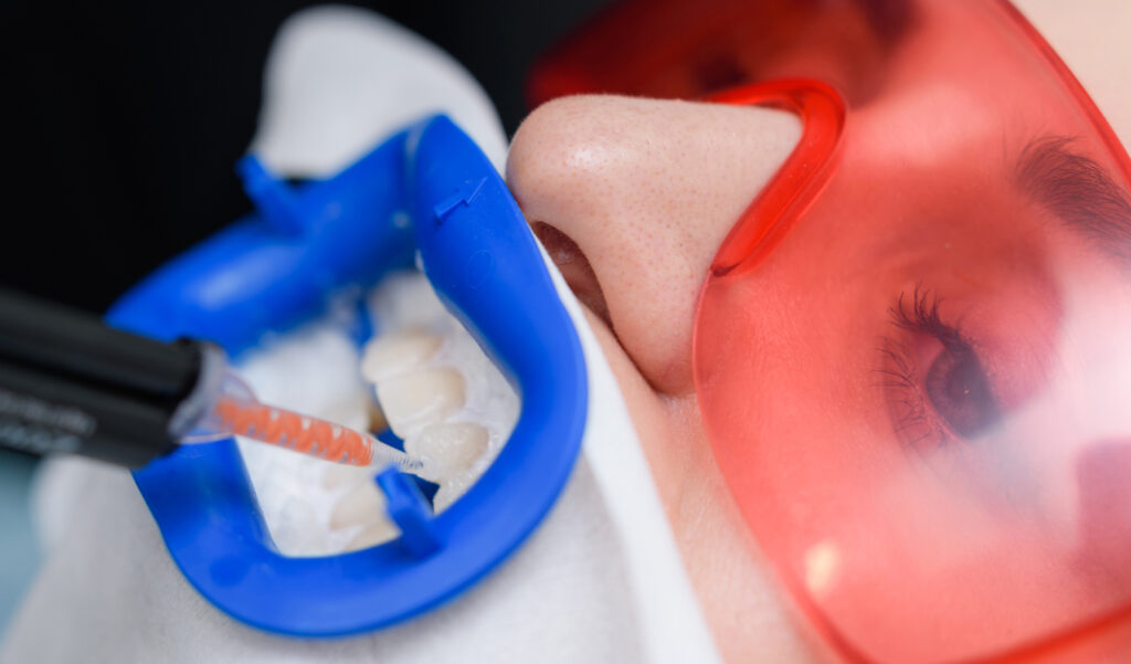 What You Need to Know About Professional Teeth Whitening