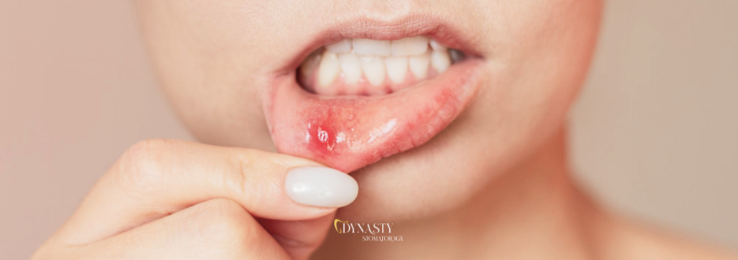 Causes and Treatment of Stomatitis – What is it and Why Does it Occur?