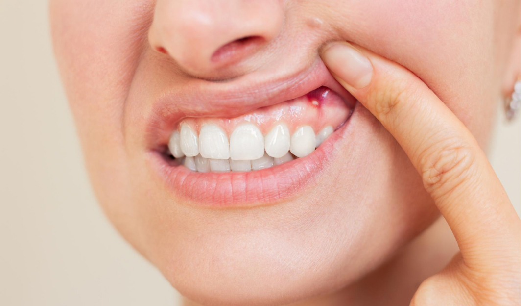 Лечение стоматита – что такое стоматит и почему он возникает?