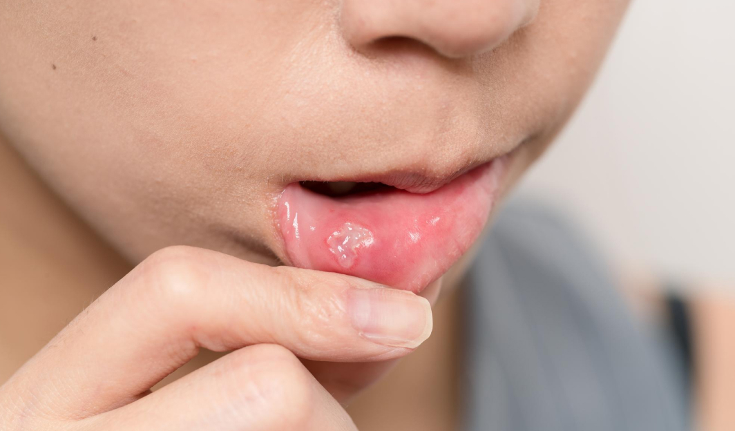 Лечение стоматита – что такое стоматит и почему он возникает?