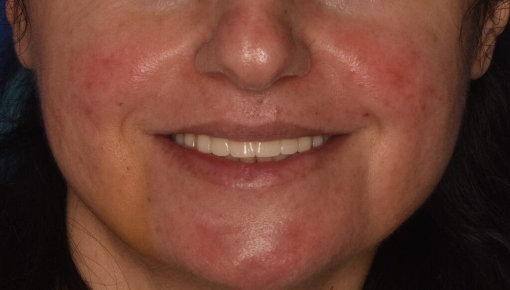Comprehensive Restoration of Masticatory Function and Smile Esthetics According to the All-on-4 Concept
