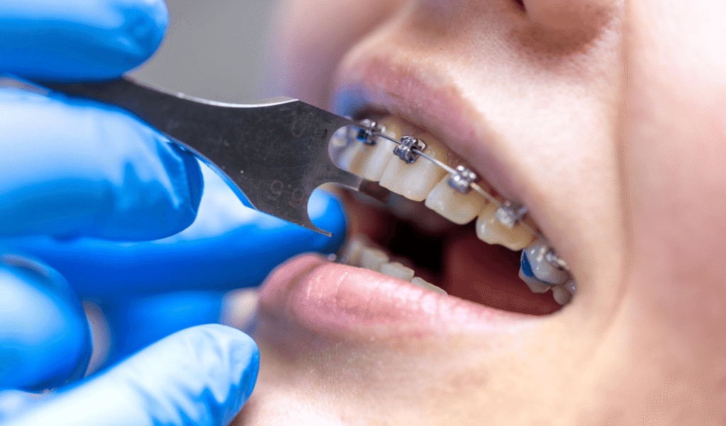 Invisalign vs Fixed Braces – What to Choose?
