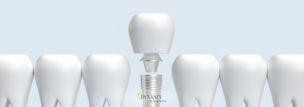 dental-implants