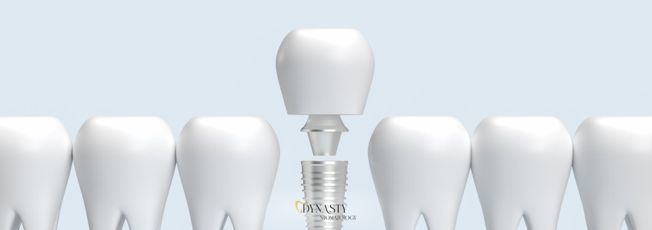 dental-implants